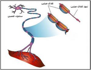 بیماری MS