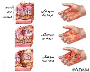 سوختگی