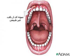 بیماری لثه