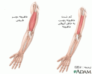 آتروفی