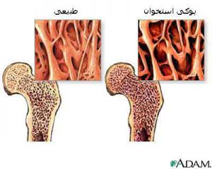 پوکی استخوان